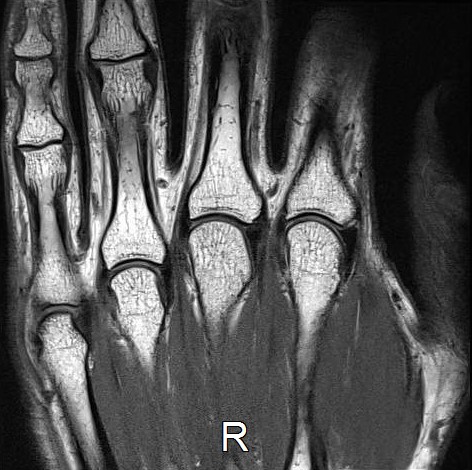 手MRI